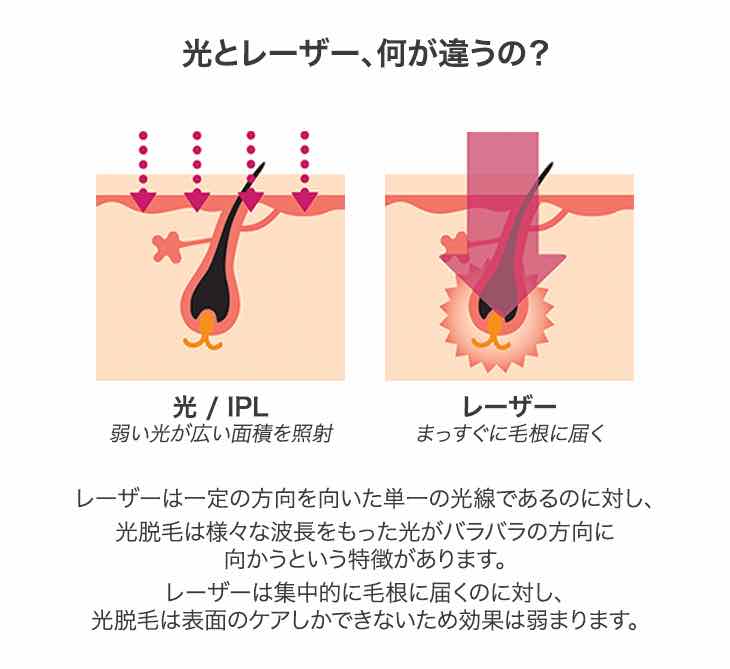 光・IPL方式とレーザー方式の違いの特徴がわかる画像